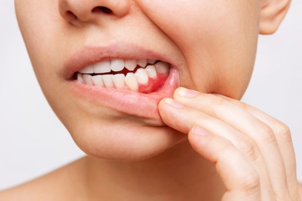 10 Cara Mencegah Penyakit Periodontal Sejak Dini 10 Cara Mencegah Penyakit Periodontal Sejak Dini