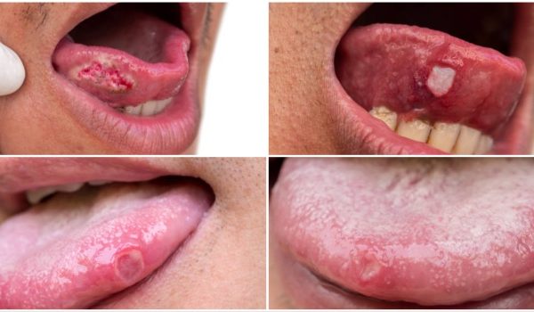 7 Langkah Menangani Luka atau Sariawan di Lidah 7 Langkah Menangani Luka atau Sariawan di Lidah