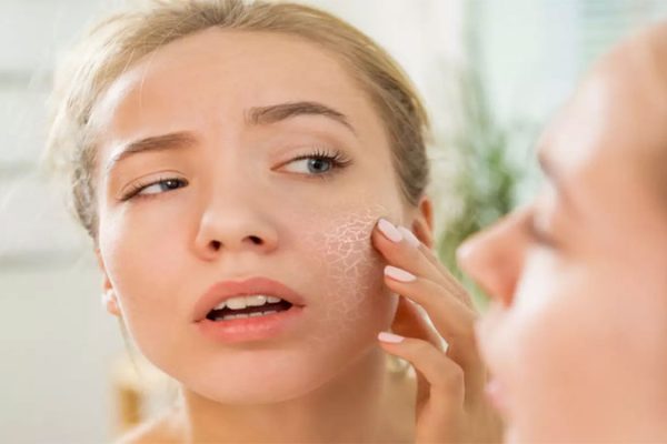 7 Cara Menangani Kulit Kering di Dagu Secara Alami