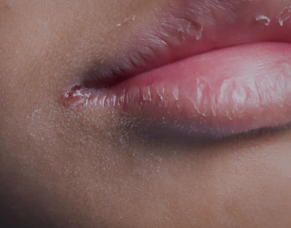 5 Kebiasaan Kecil yang Bisa Merusak Kesehatan Bibir